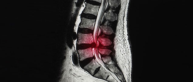 herniated disc chiropractor in Ontario, CA