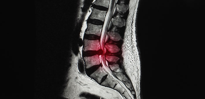 patient needing herniated disc treatment in Ontario