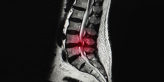 disc injury Treatment in Ontario