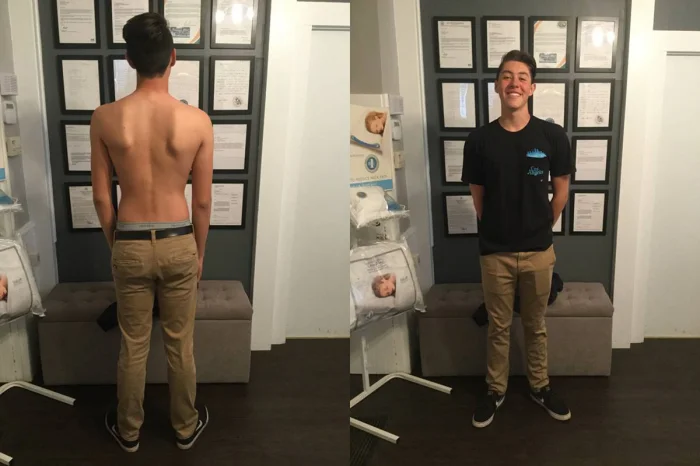 La Verne Scoliosis Chiropractic Treatment tips from Ontario chiropractor